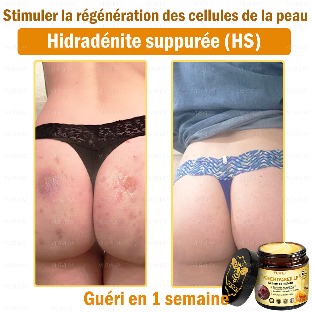 VLSVLS® Venin D'Abeille Crème Complète 🎉🎉(Convient à tous les âges & recommandé par la SFD)